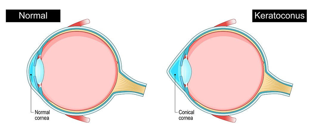 pec-keratoconus
